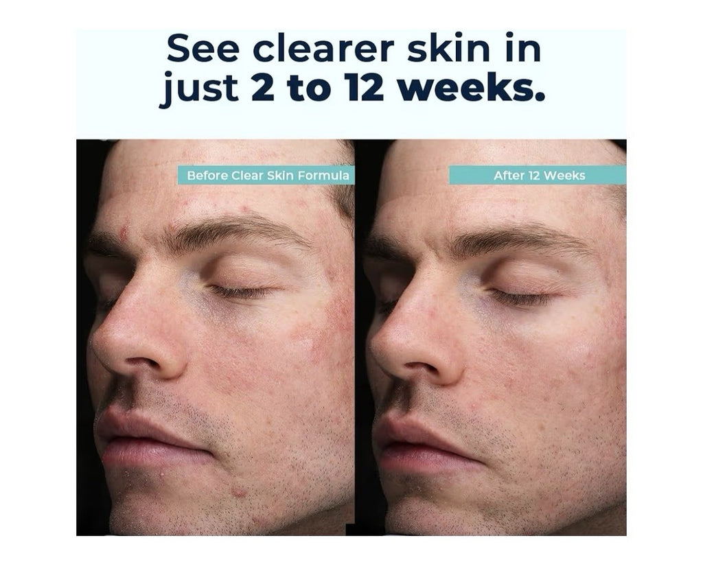 VitaMedica Clear Skin Formula Skin Clarifying Supplement For Women & Men 60caps