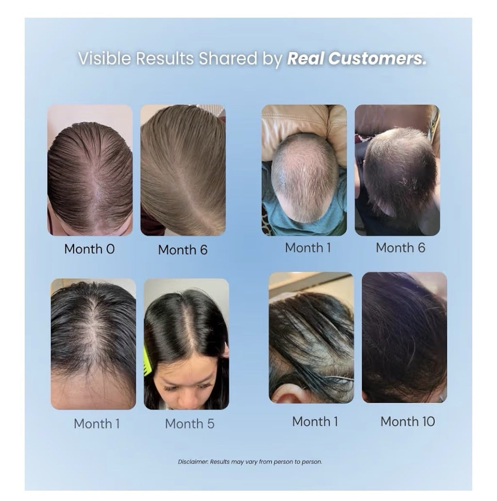 Growplex Vitafoam Hair Growth Bundle Scalp Care Foam + Complex10 Hair Supplement