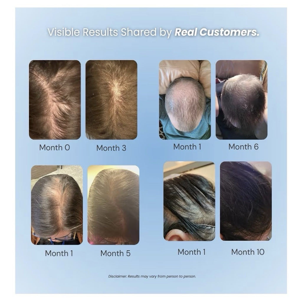 Vitafoam 5% Minoxidil Foam for Men & Women DHT Blocking Minoxidil Hair Regrowth