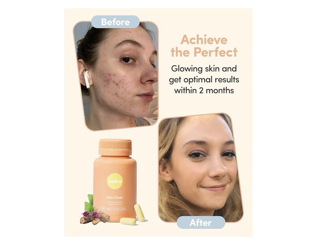 2 Packs Ovira Skin Clear with ZINCBRIGHT for Clear & Glowing Skin Acne Treatment