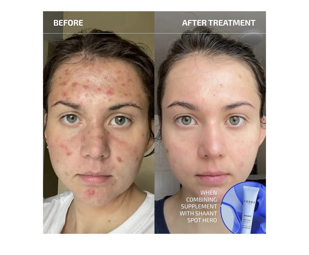 Codex Labs Shaant Clear Skin 2.0 Acne Prone Probiotics Supplement 60 Capsules