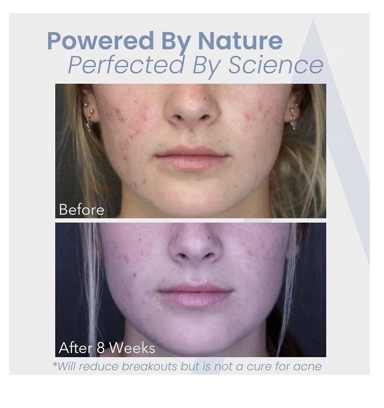 Augamis Clear Skin Nutraceutical Original Formula Acne Treatment 3 Pack